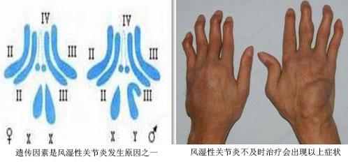 貴陽強(qiáng)直醫(yī)院風(fēng)濕性關(guān)節(jié)炎遺傳