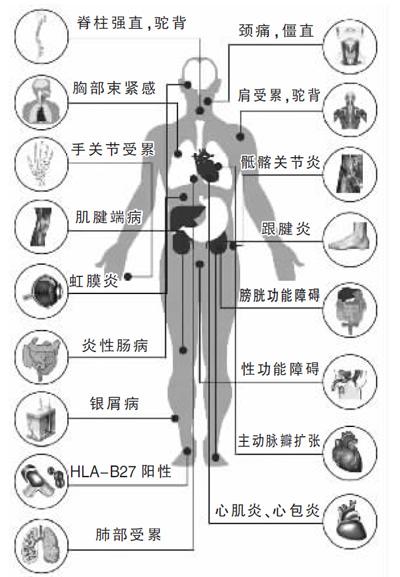 貴陽(yáng)強(qiáng)直醫(yī)院強(qiáng)直性脊柱炎的危害可累及全身.jpg