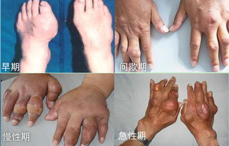 貴陽(yáng)強(qiáng)直醫(yī)院痛風(fēng)發(fā)病的四個(gè)時(shí)期癥狀.jpg